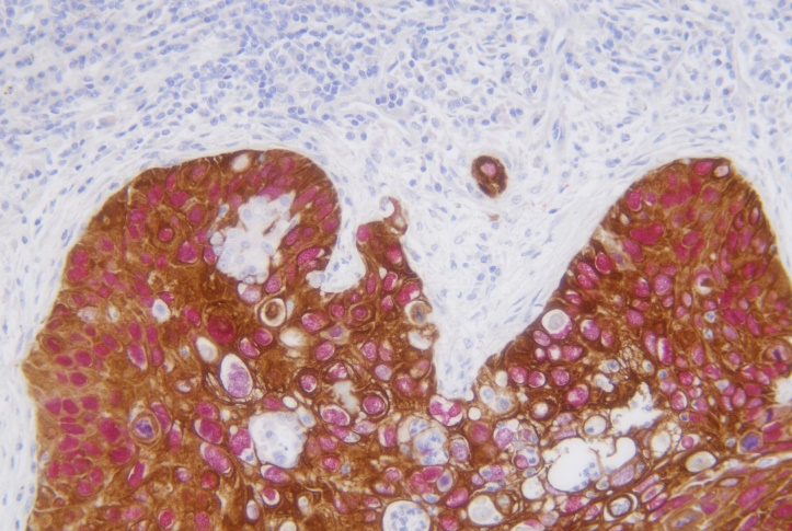 CK5/6/p40 detection reagent (Immunohistochemical)