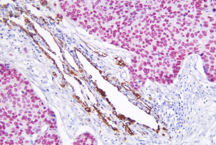 Napsin A/p40 detection reagent (Immunohistochemical)