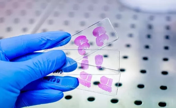 Understanding the IHC Single Marker Test: Why It Matters in Diagnosis