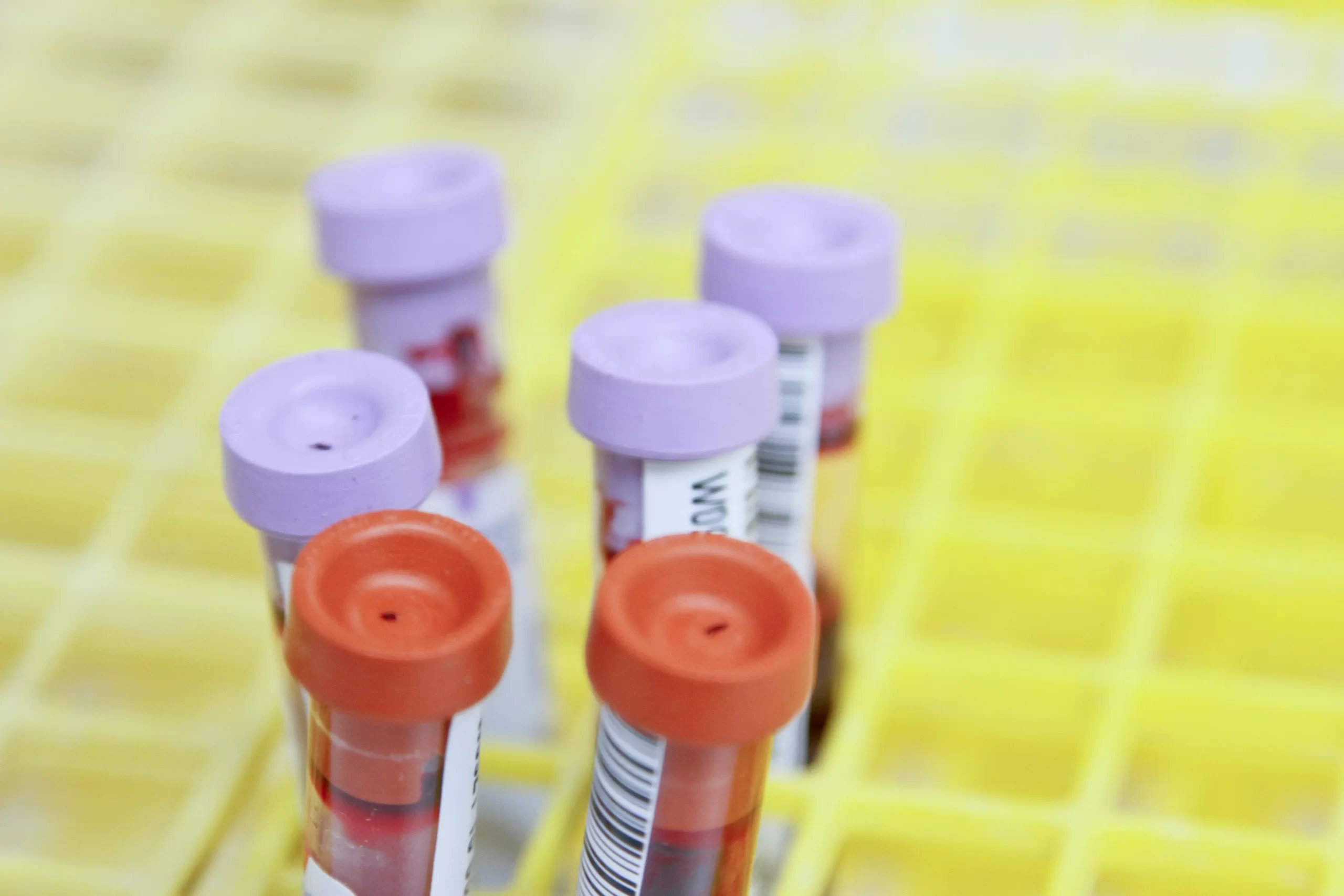 Kappa vs. Lambda Light Chains: Key Differences and Their Role in Antibody Production