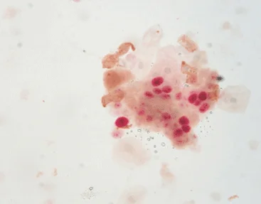 Multiplex Immunohistochemistry for Tumor-Infiltrating Lymphocytes (TILs) Analysis