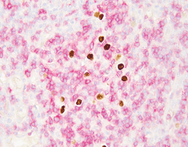 Why EBER ISH Isn’t the Same as EBV IHC And Why It Matters